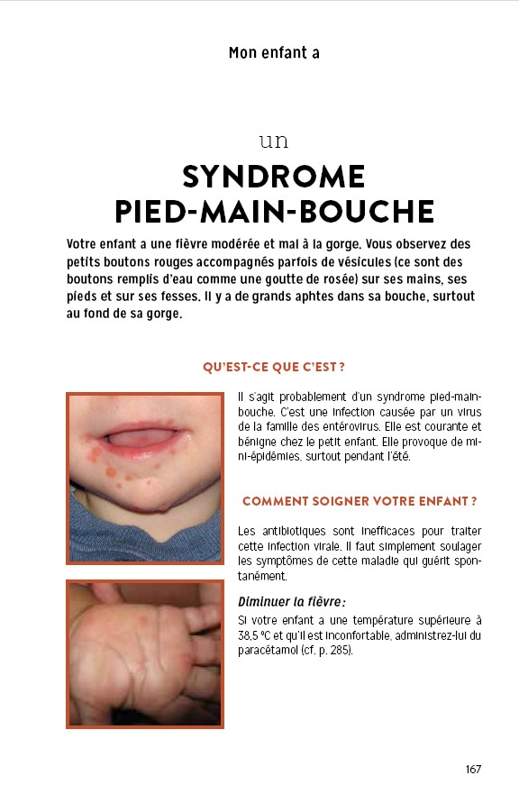 Syndrome pied-main-bouche